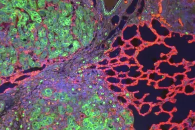 Green and pink lung tumor angiogenesis cells.