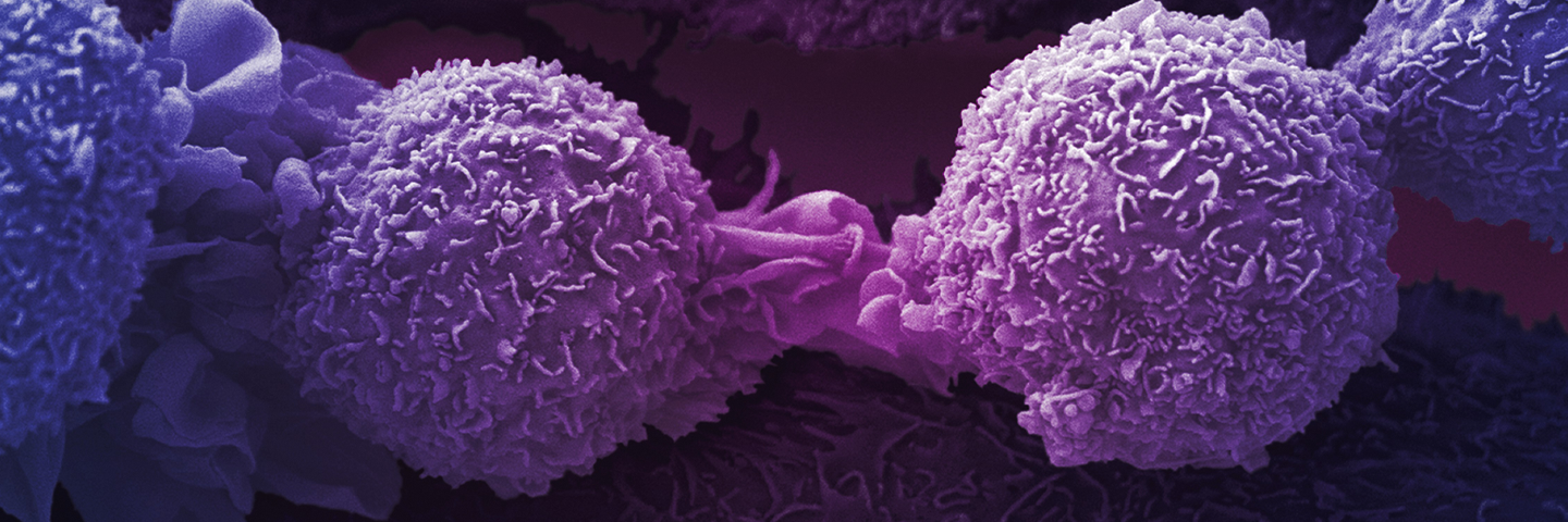 Purple lung cancer cells.