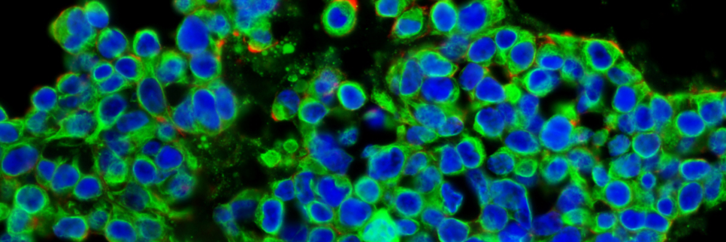 Blue and green metastatic carcinoma cells.