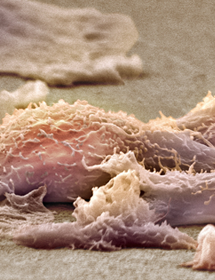 Sarcoma soft tissue cancer cells.