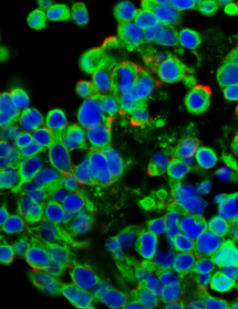 Blue and green metastatic carcinoma cells.