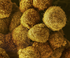 Yellow pancreatic cancer cells.