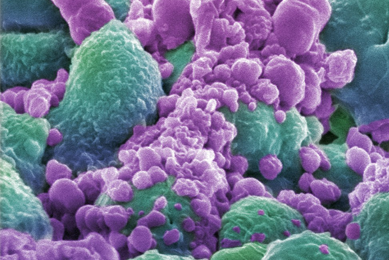 Green and purple breast cancer cells.