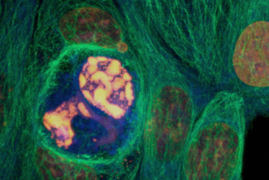 Breast cancer cells.