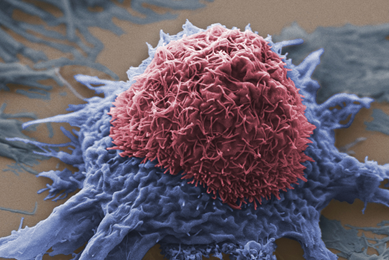 Blue and red lung cancer cells.