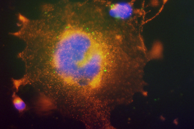 Blue and orange neuroblastoma cell.