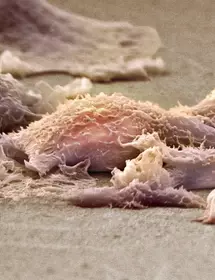 Sarcoma soft tissue cancer cells.