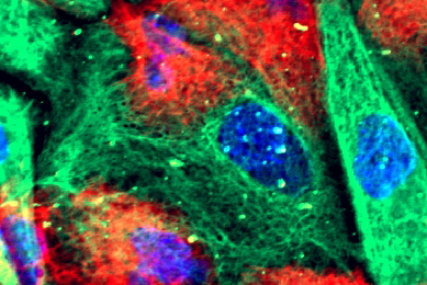 Fluorescent green, blue, and red prostate cancer organoid xenograft.