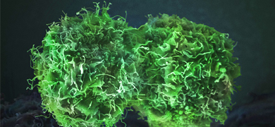 Round, green, lettuce-like skin cancer cells.