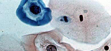 Pink and blue human papillomavirus spheres with dark circles in the middle.