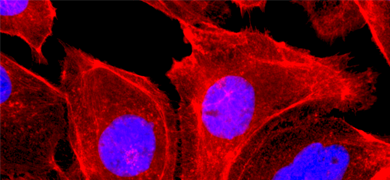 Fluorescent red and purple colon cancer epithelial cells.