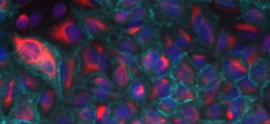Fluorescent blue, purple, and pink, lung, epithelial mesenchymal transition reporter cells.