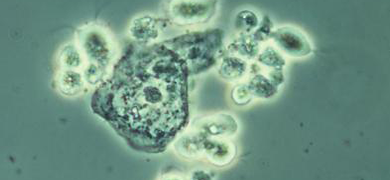 Clusters of  round, fluorescent green-gray Trichomonas vaginalis.