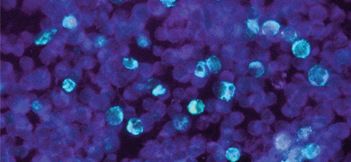 Blue and purple leukemia cells containing epstein barr virus.