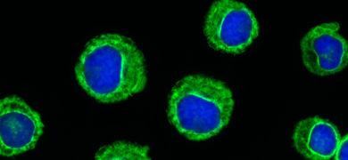 Fluorescent blue and green spheres of leukemic cells.