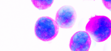 Fluorescent blue and pink spheres of leukemic cells.