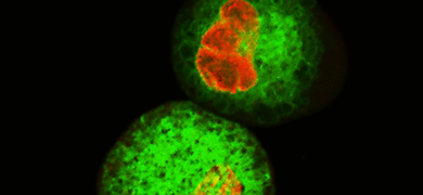 Fluorescent orange and lime green spheres of human leukemic cells.