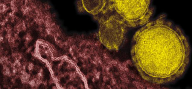 Grainy, pink and yellow spheres of Middle East respiratory syndrome coronavirus.