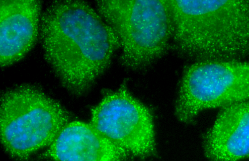 Fluorescent green and blue adenocarciona mammary gland cells.