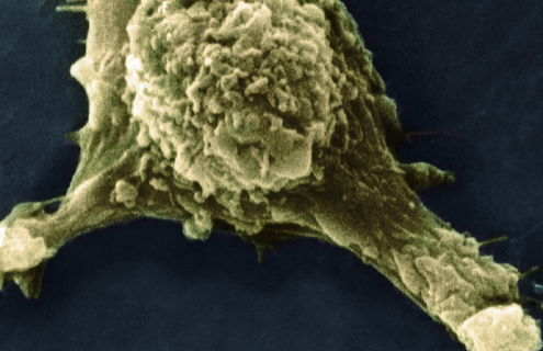 Metastasis melanoma cell with protrusion.