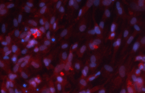 Pink and blue Parkinsons cells.