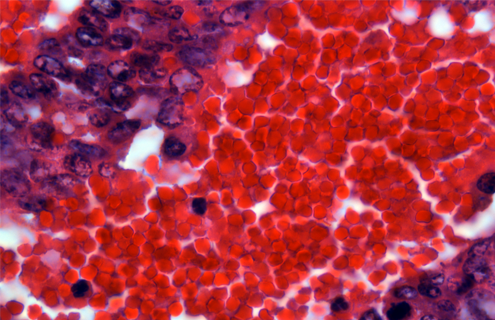Red and purple tumor metastasis.