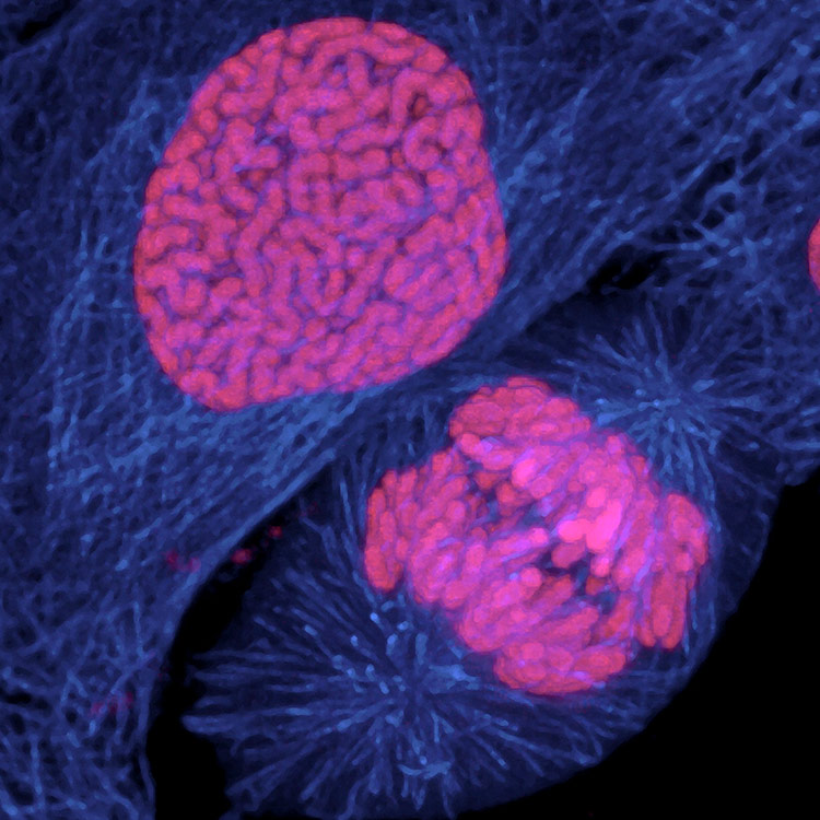 Human breast cancer cell dividing.