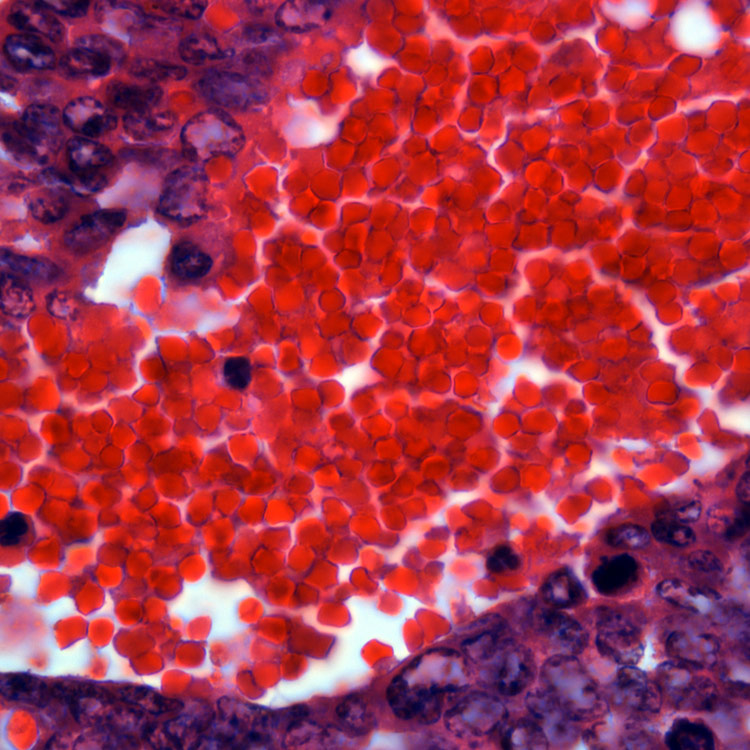 Red and purple tumor metastasis.