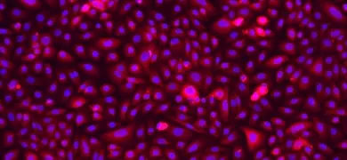 Pink and blue lung epithelial cystic fibrosis cells.