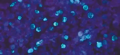 Photomicrograph depicted leukemia cells that contained Epstein-Barr virus (EBV), using a fluorescent antibody (FA) staining technique, which caused the affected cells to glow green under ultraviolet light.