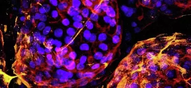 lung epithelial carcinoma