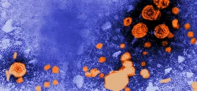 Transmission electron microscopic (TEM) image revealed the presence of hepatitis B virus (HBV) particles (orange). The round virions, which measure 42nm in diameter, are known as Dane particles.