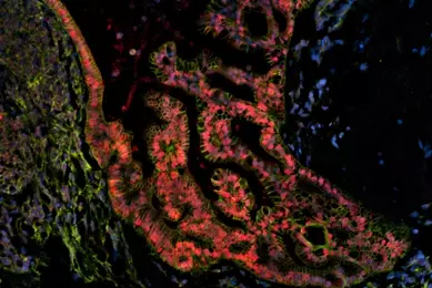 ATCC’s Diverse Collection of Patient-derived Cancer Models from the ...
