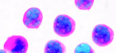 Fluorescently labeled leukemic cells under a microscope, shown in vivid blue and pink colors on a white background.