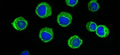 Fluorescent blue and green spheres of leukemic cells.