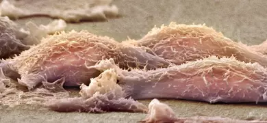 Sarcoma soft tissue cancer cells.