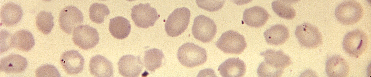 Photomicrograph of a blood smear showing a tetrad configuration of Babesia species trophozoites, which can resemble Plasmodium falciparum but differ in shape, size variability, and lack of pigment production.