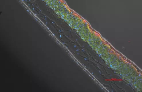 Ker-ct filiggrin epithelial cells.