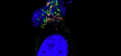 Fluorescent microscopy image of a human HeLa cell infected with Escherichia coli, showing a large blue-stained nucleus and clusters of blurry blue, green, and orange bacterial structures around the cell.