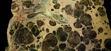 Histological image showing extensive metastatic melanoma lesions in liver tissue, with numerous darkly pigmented tumor nodules.