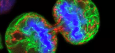 Human melanoma cell dividing.