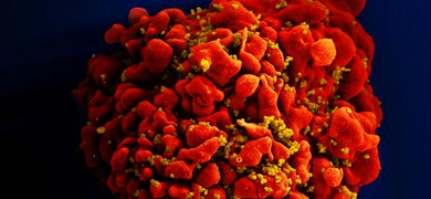 Digitally colorized scanning electron micrograph showing a red H9-T cell infected with numerous mustard-colored HIV particles attached to its surface membrane.