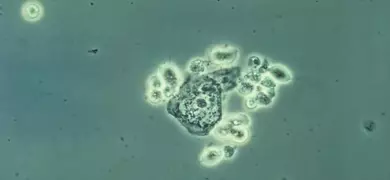 Clusters of round, fluorescent green-gray Trichomonas vaginalis.
