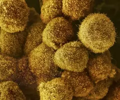 Yellow pancreatic cancer cells