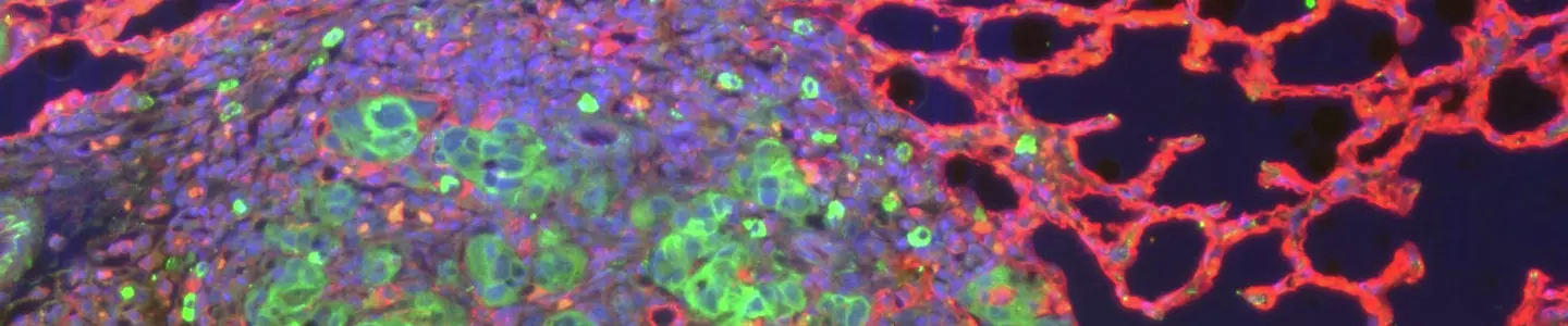 Green and pink lung tumor angiogenesis cells.