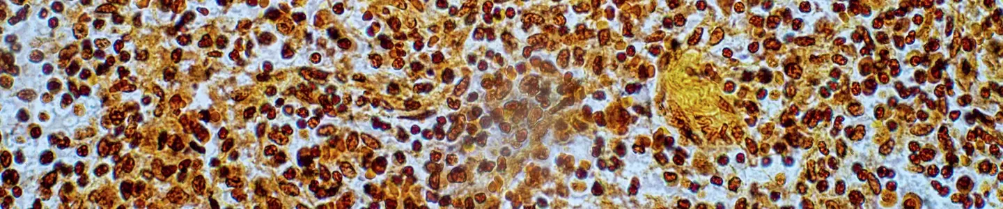 A histological microscopy image shows densely packed hepatocytes with brown immunohistochemical staining highlighting cytoplasmic structures, surrounded by numerous dark‑stained nuclei. The tissue displays an organized cellular pattern typical of liver parenchyma with areas of increased staining intensity.