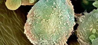 Lymphoma cancer cells, green and brown.