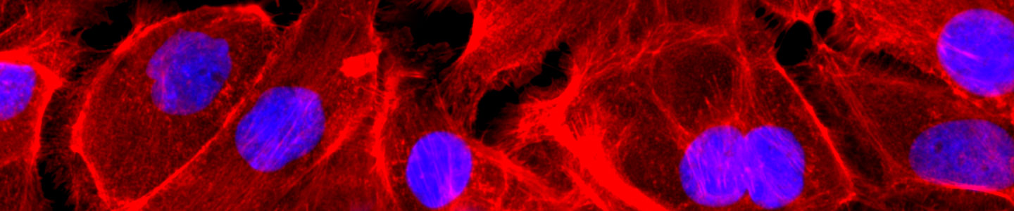 Fluorescent red and purple colon cancer epithelial cells.