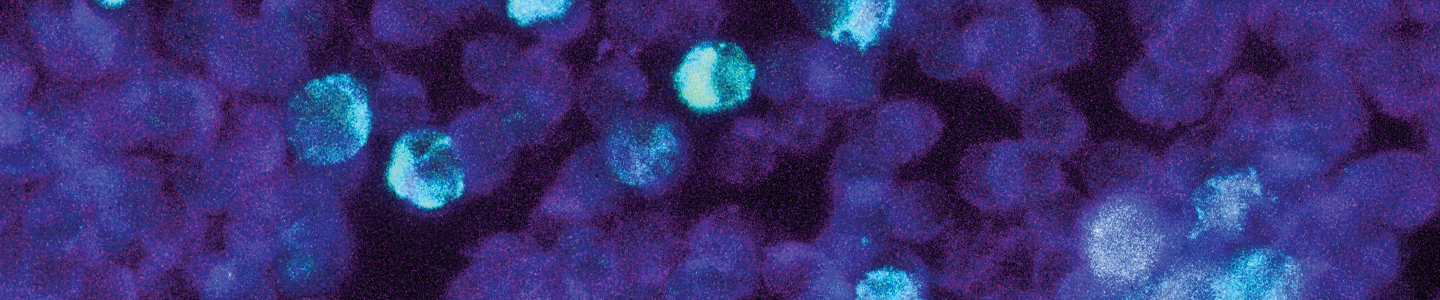 Blue and purple leukemia cells containing epstein barr virus.