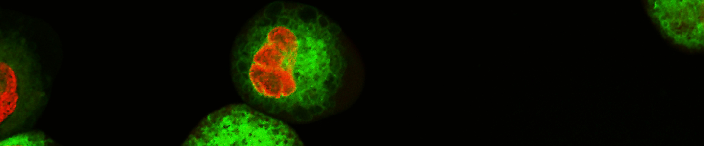 Fluorescent orange and lime green spheres of human leukemic cells.